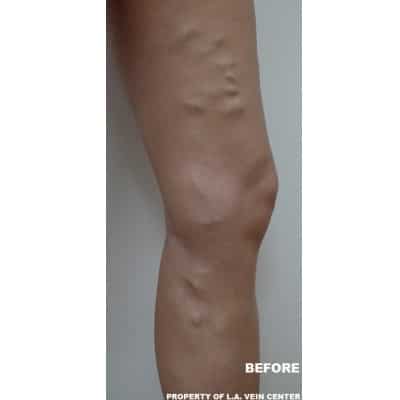 Before Image: Varicose Veins - other
