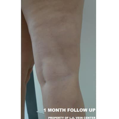 After Image: Varicose Veins - back