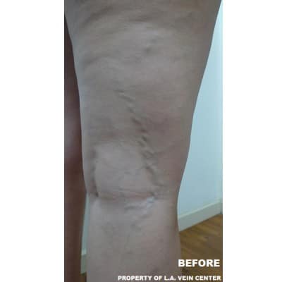 Before Image: Varicose Veins - back