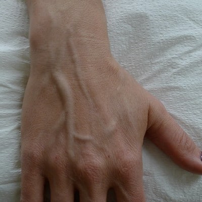 Before Image: Hand Treatment - front