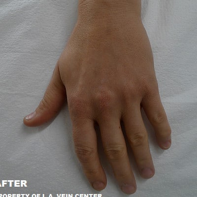 After Image: Hand Vein Treatment - front
