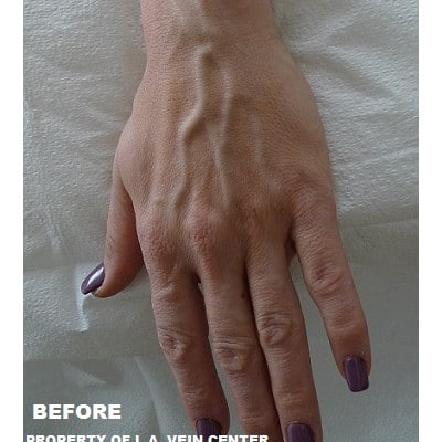 Before Image: Hand Vein Treatment - front