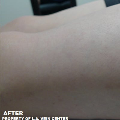 After Image: Spider Veins - front