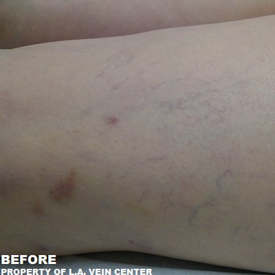 Before Image: Spider Veins - front