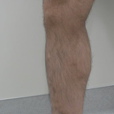 After Image: Varicose Veins - front