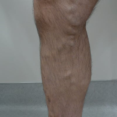 Before Image: Varicose Veins - front