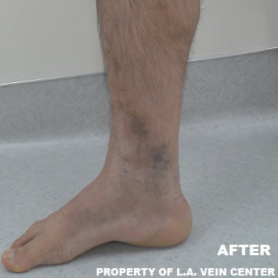 After Image: Venous Ulcer - front