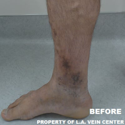Before Image: Venous Ulcer - front