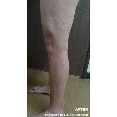 After Image: Varicose Veins - front