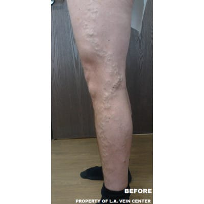Before Image: Varicose Veins - front