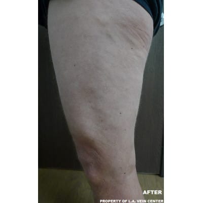 After Image: Varicose Veins - front