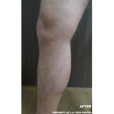 After Image: Varicose Veins - front