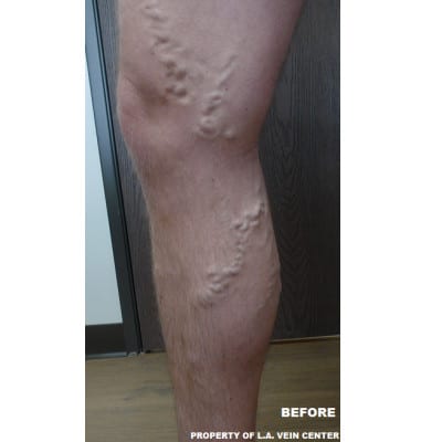 Before Image: Varicose Veins - front