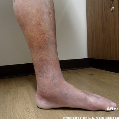After Image: Venous Ulcer - other