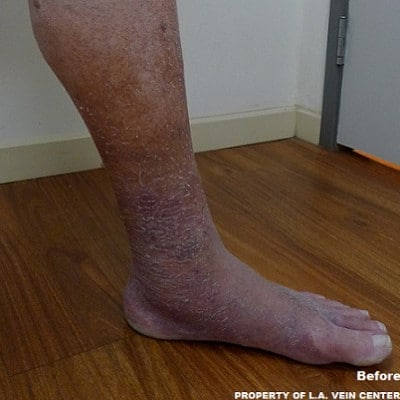 Before Image: Venous Ulcer - other