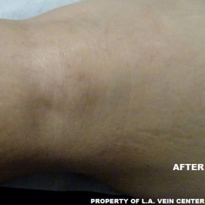 After Image: Spider Veins - back