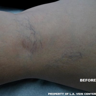 Before Image: Spider Veins - back