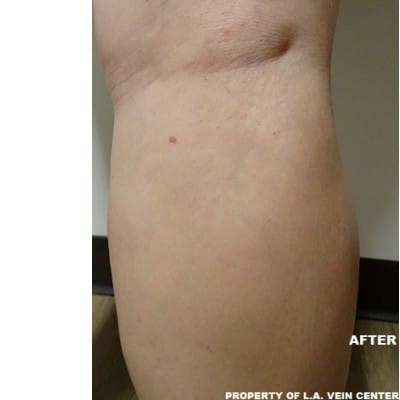 After Image: Spider Veins - back
