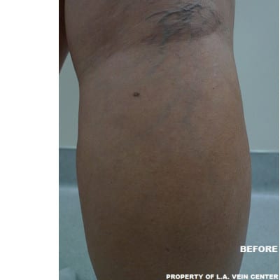 Before Image: Spider Veins - back