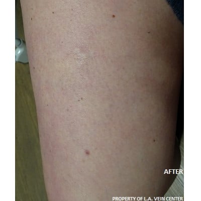 After Image: Spider Vein Treatment - front