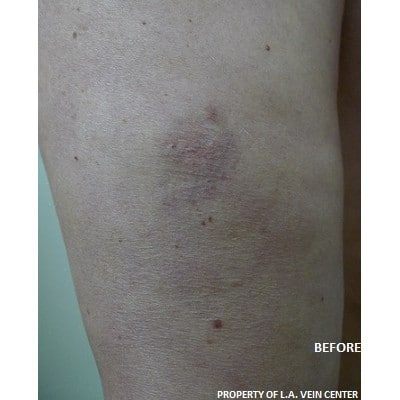 Before Image: Spider Vein Treatment - front