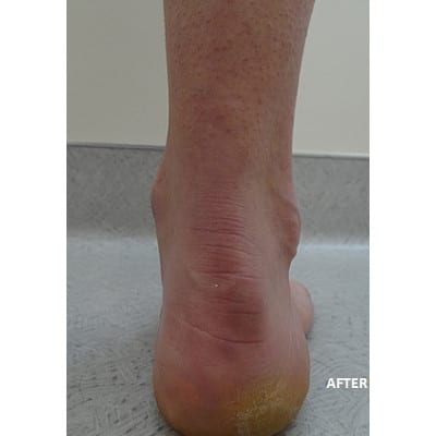 After Image: Varicose Veins - front
