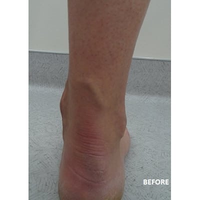 Before Image: Varicose Veins - front