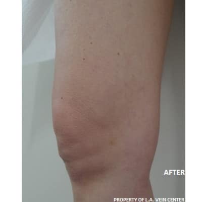 After Image: Spider Vein Treatment - front