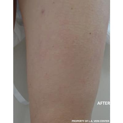 After Image: Spider Vein Treatment - front