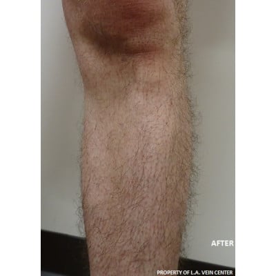After Image: Varicose Veins - front