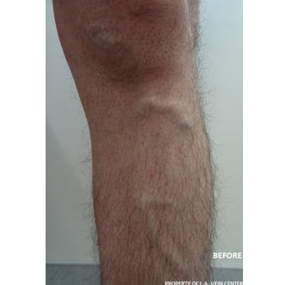 Before Image: Varicose Veins - front