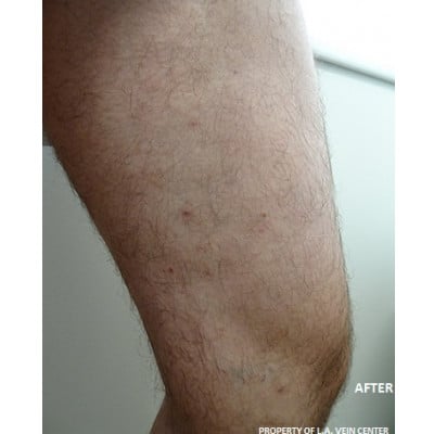 After Image: Varicose Veins - other