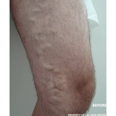 Before Image: Varicose Veins - other