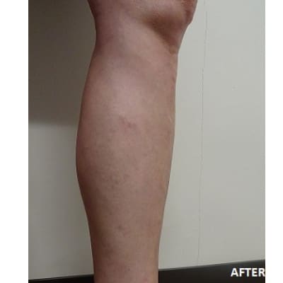 After Image: Varicose Veins - front
