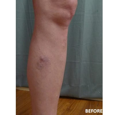 Before Image: Varicose Veins - front
