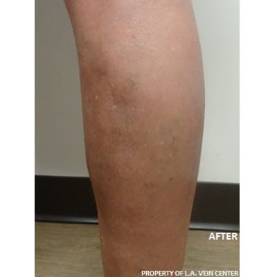 After Image: Varicose Veins - front