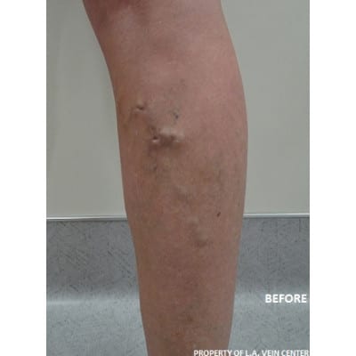 Before Image: Varicose Veins - front