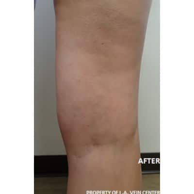 After Image: Spider Vein Treatment - front