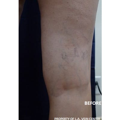Before Image: Spider Vein Treatment - front