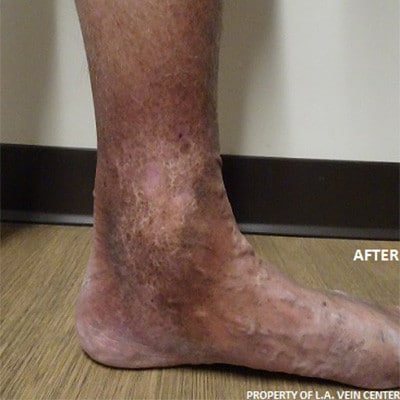 After Image: Venous Ulcer - other