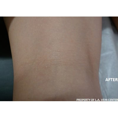 After Image: Spider Vein Treatment - other