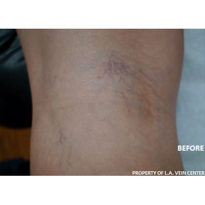 Before Image: Spider Vein Treatment - other