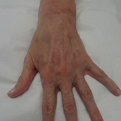 After Image: Phlebectomy - other