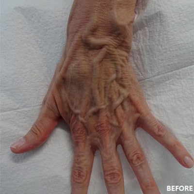 Before Image: Phlebectomy - other